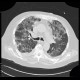 Pneumocystis carinii, HRCT: CT - Computed tomography